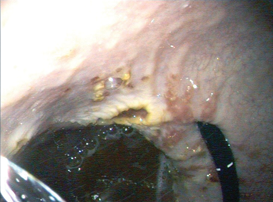 Gastric ulcer