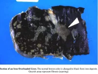 iron_liver.webp